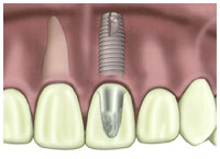Dental Implants Dental Implants