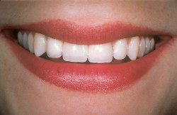 implant dentistry at Lake Forest Dental Dental implant