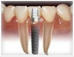 dental tourism implants dental tourism implants